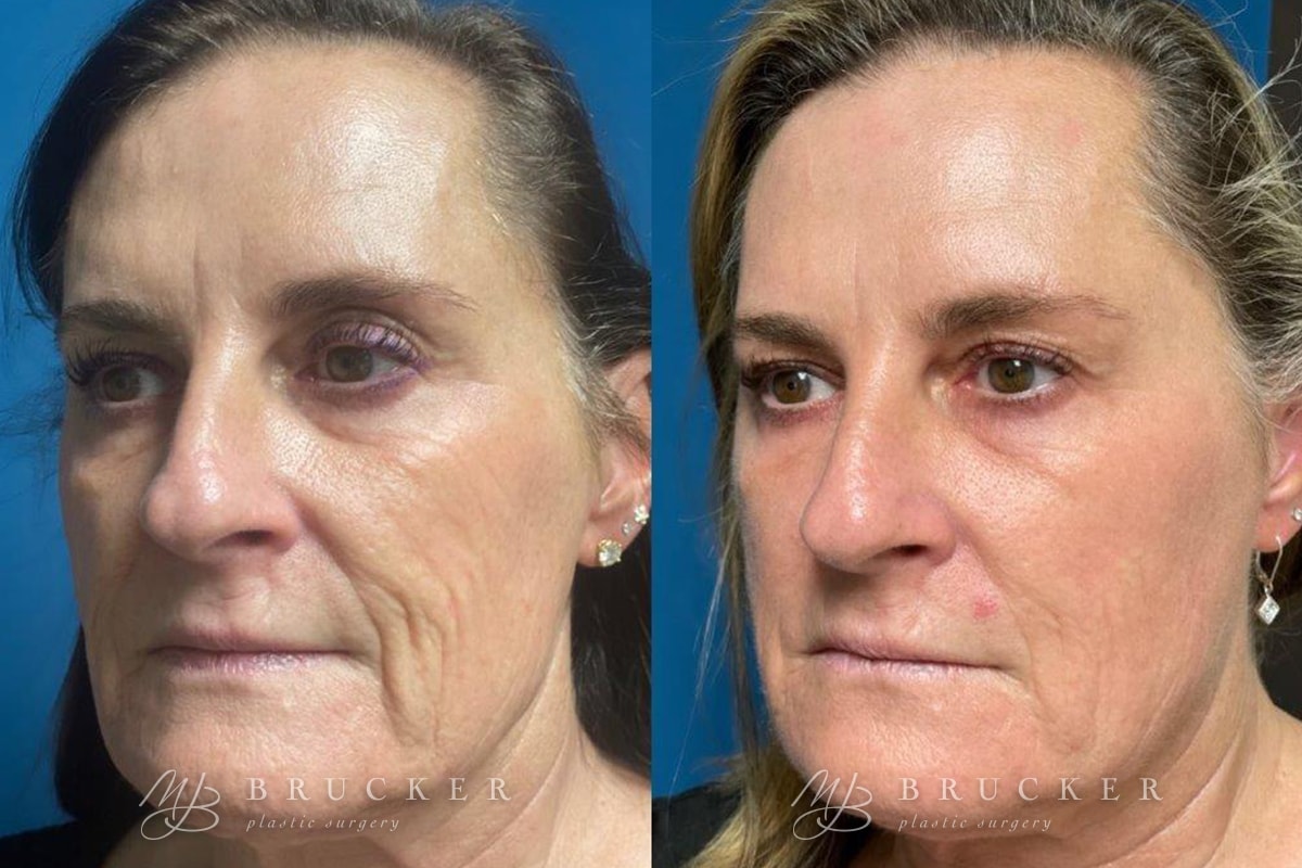 A result from Brucker Plastic Surgery
