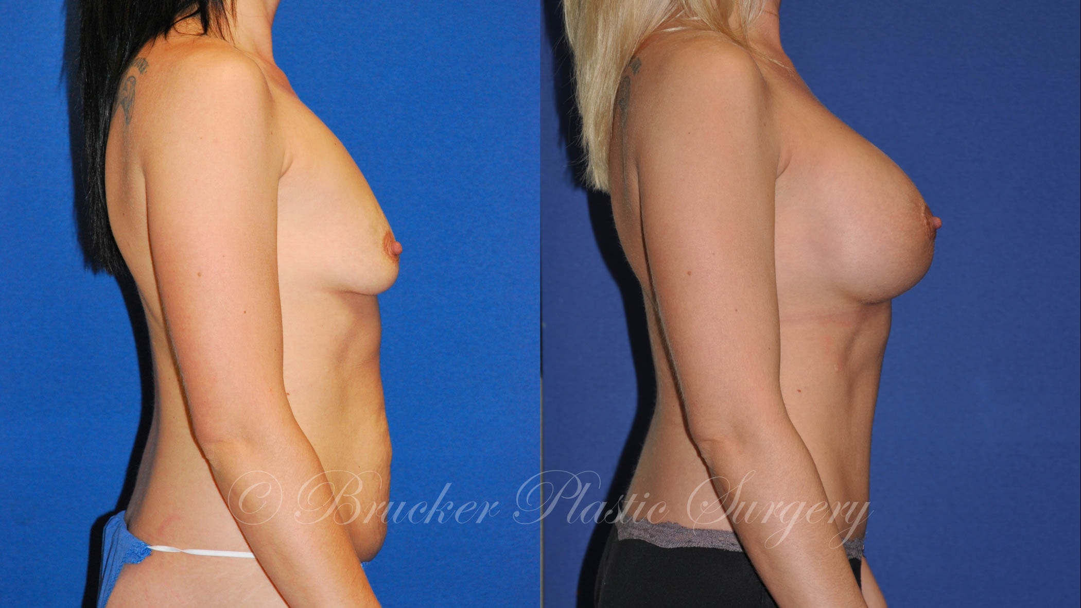 A result from Brucker Plastic Surgery