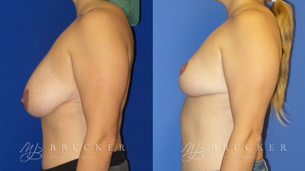 A result from Brucker Plastic Surgery