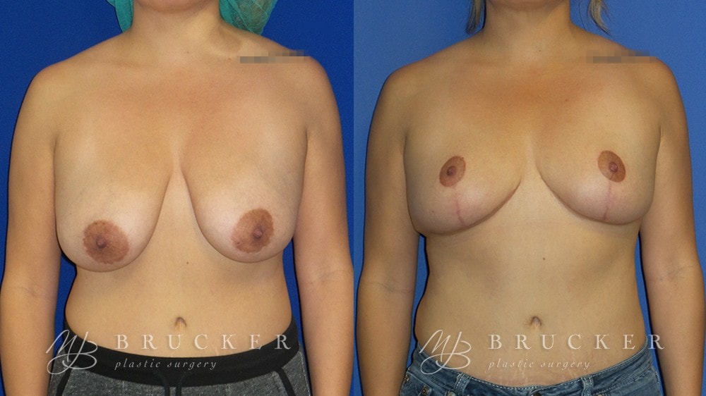 A result from Brucker Plastic Surgery