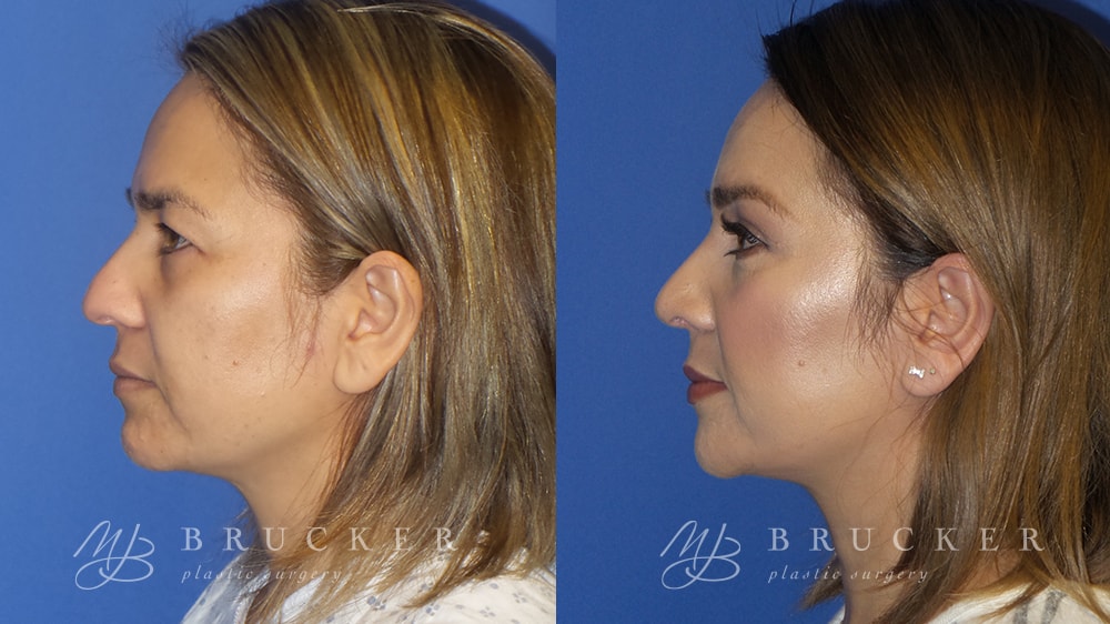 A result from Brucker Plastic Surgery