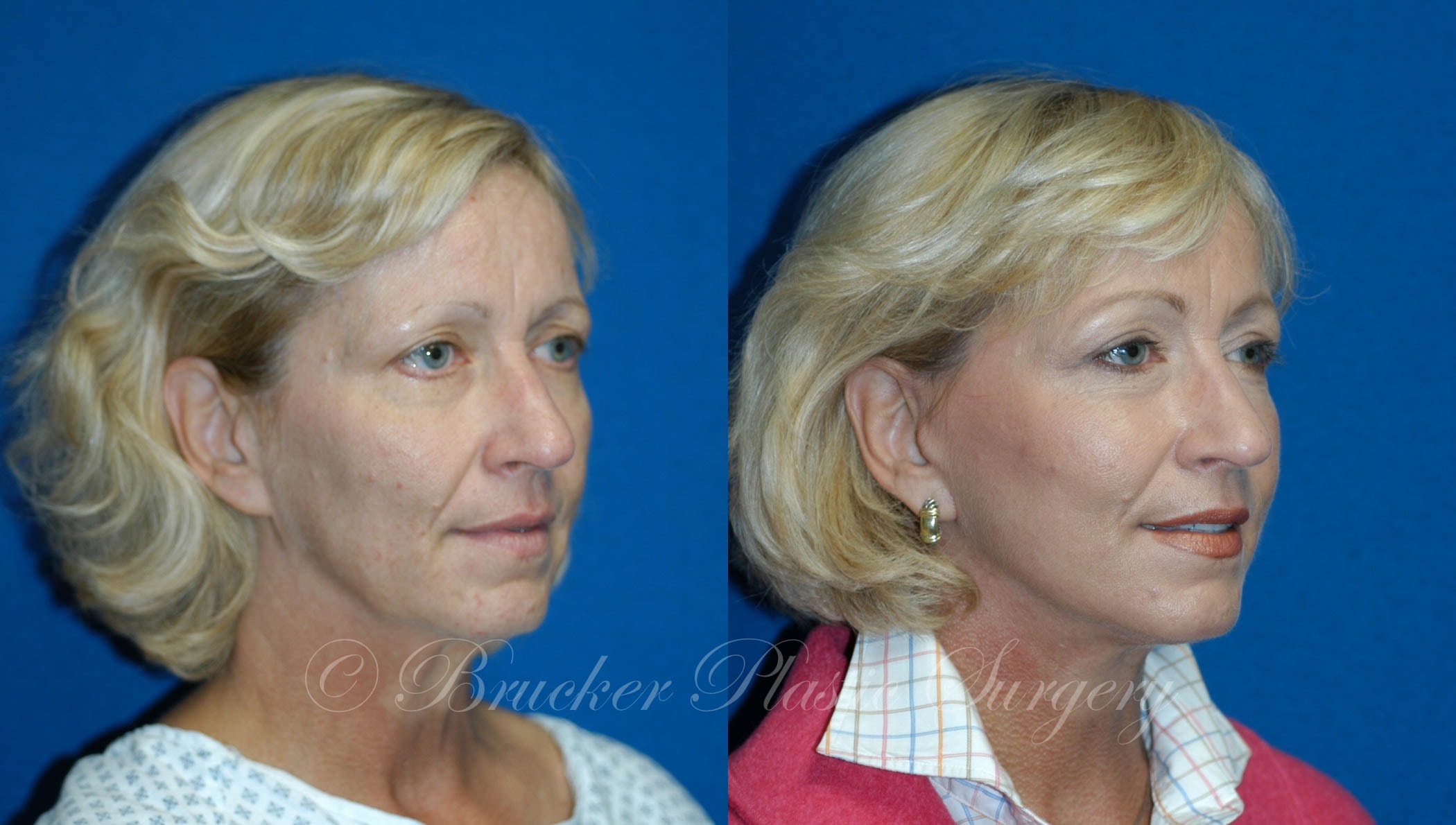 A result from Brucker Plastic Surgery