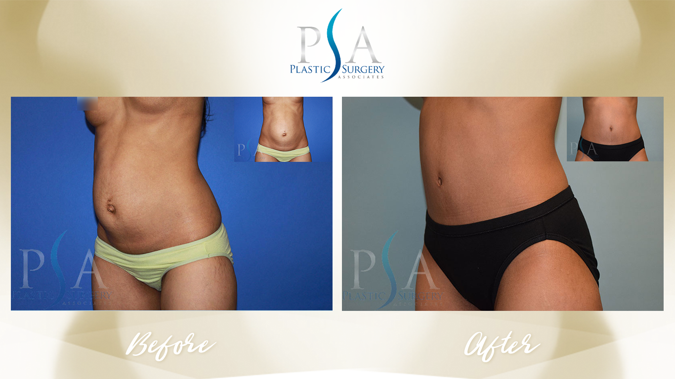 Tummy Tuck result at Plastic Surgeon Associates of Orange County