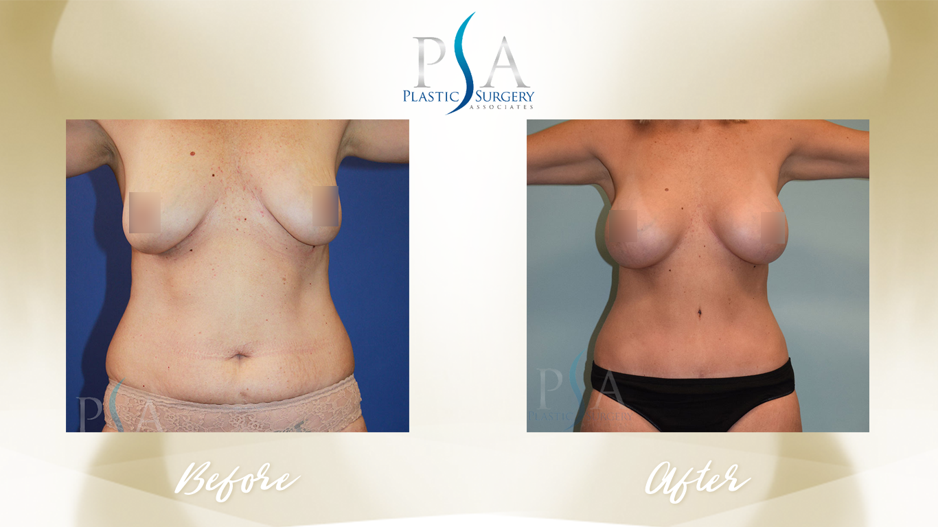Mommy Makeover result at Plastic Surgeon Associates of Orange County