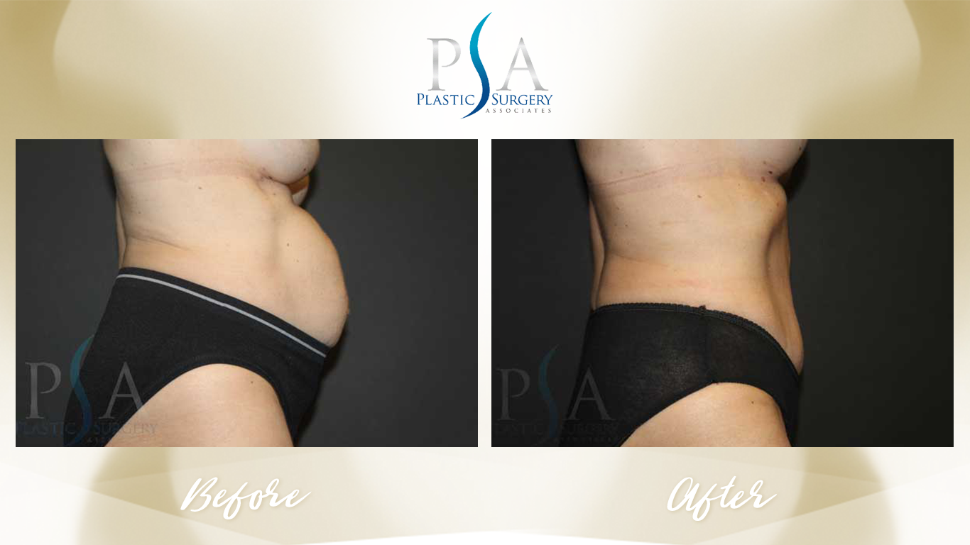 Tummy Tuck result at Plastic Surgeon Associates of Orange County