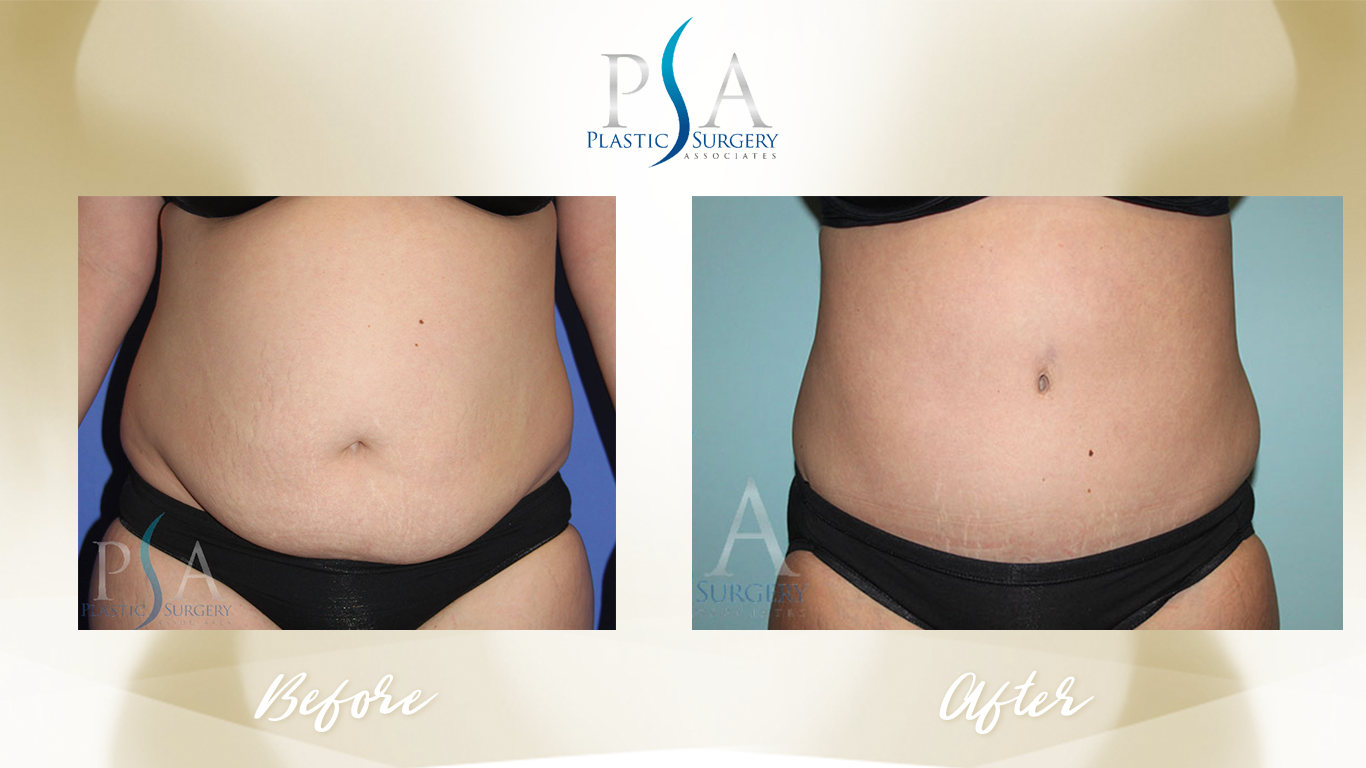 Tummy Tuck result at Plastic Surgeon Associates of Orange County