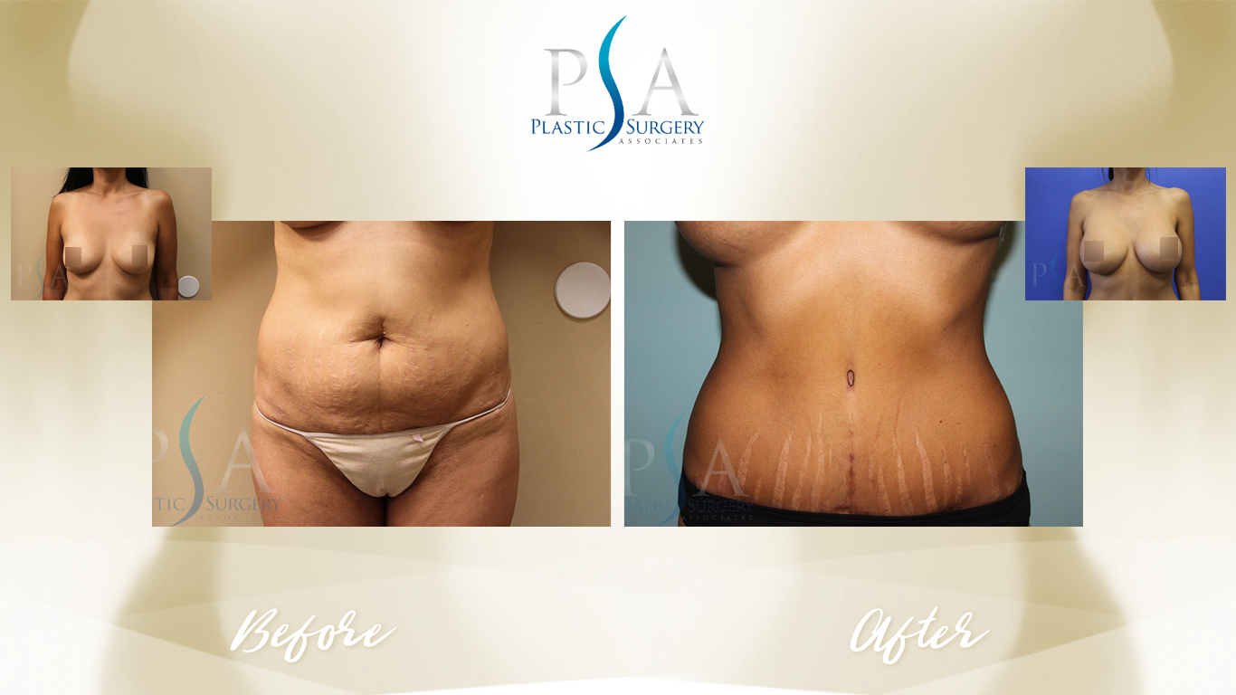 Mommy Makeover result at Plastic Surgeon Associates of Orange County