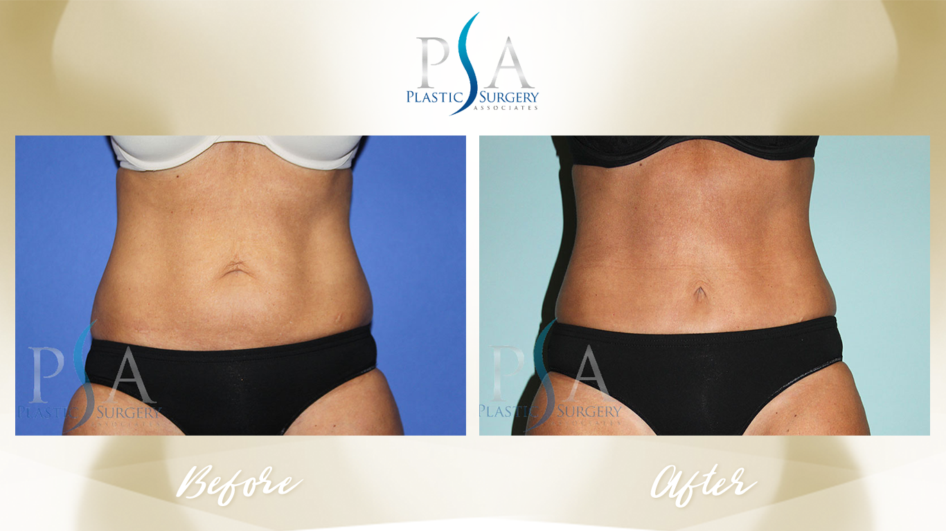 Tummy Tuck result at Plastic Surgeon Associates of Orange County