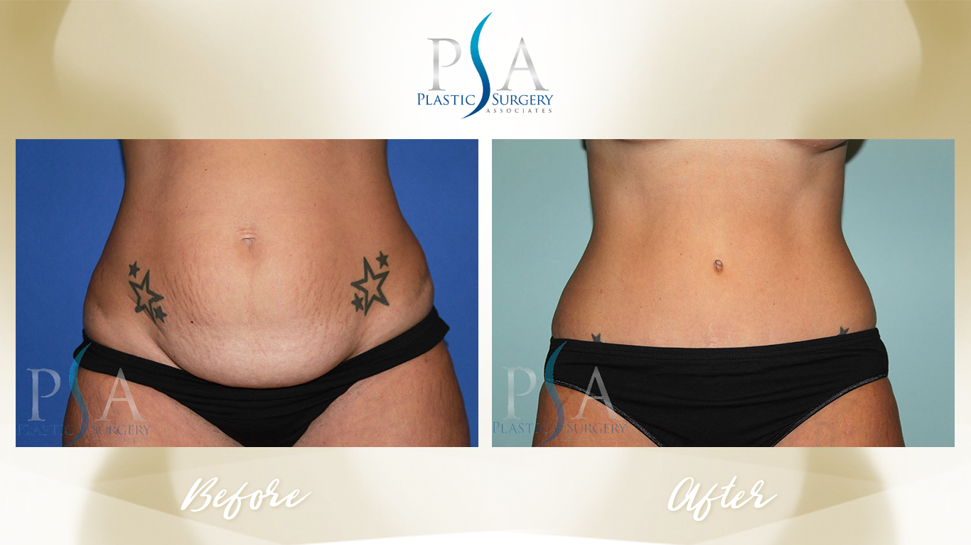 Tummy Tuck result at Plastic Surgeon Associates of Orange County