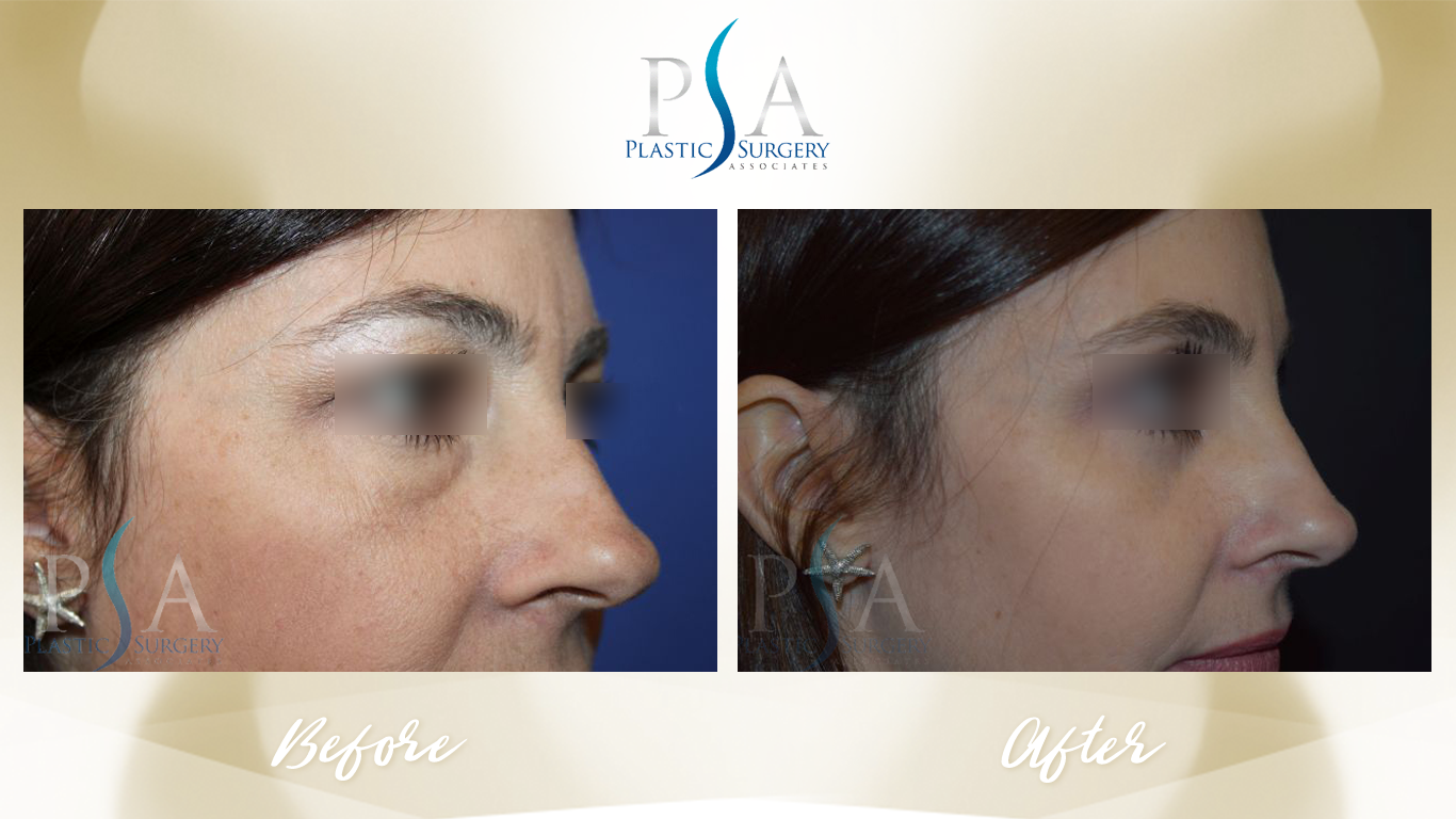 Blepharoplasty result at Plastic Surgeon Associates of Orange County