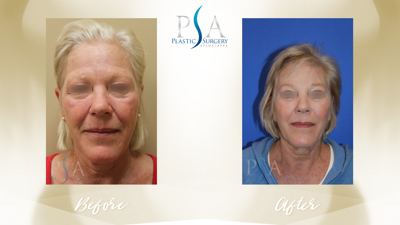 Brow Lift result at Plastic Surgeon Associates of Orange County