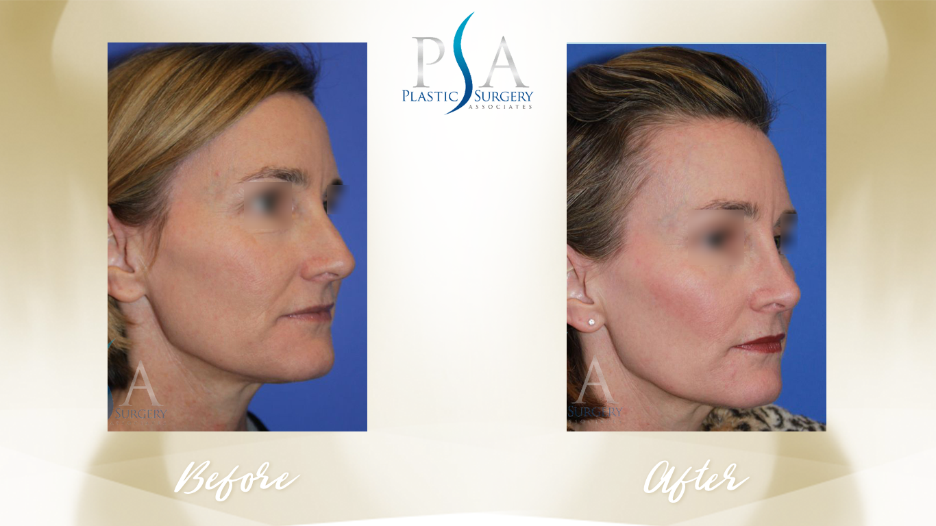 Rhinoplasty result at Plastic Surgeon Associates of Orange County