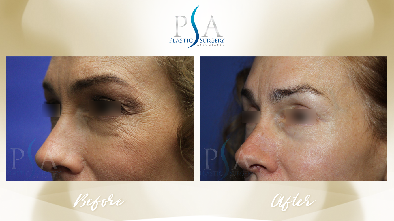Blepharoplasty result at Plastic Surgeon Associates of Orange County