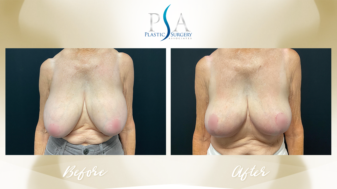 Breast Reduction result at Plastic Surgeon Associates of Orange County