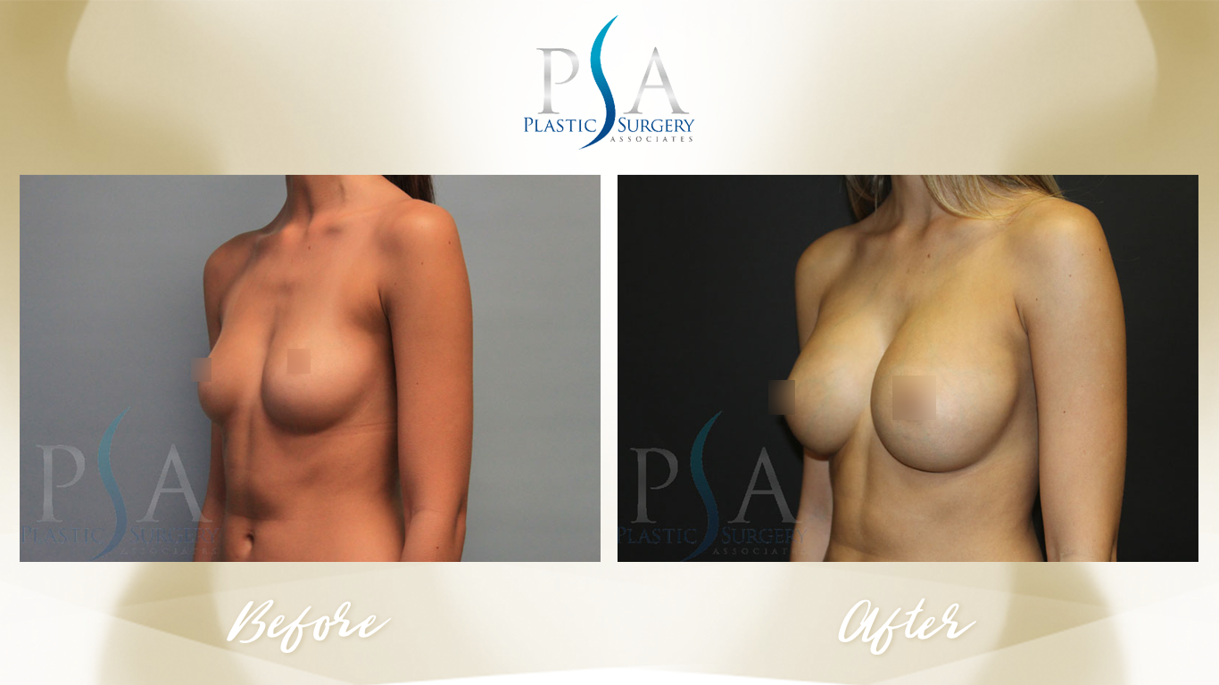 Breast Augmentation result at Plastic Surgeon Associates of Orange County