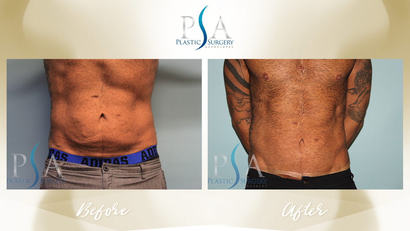 Tummy Tuck result at Plastic Surgeon Associates of Orange County