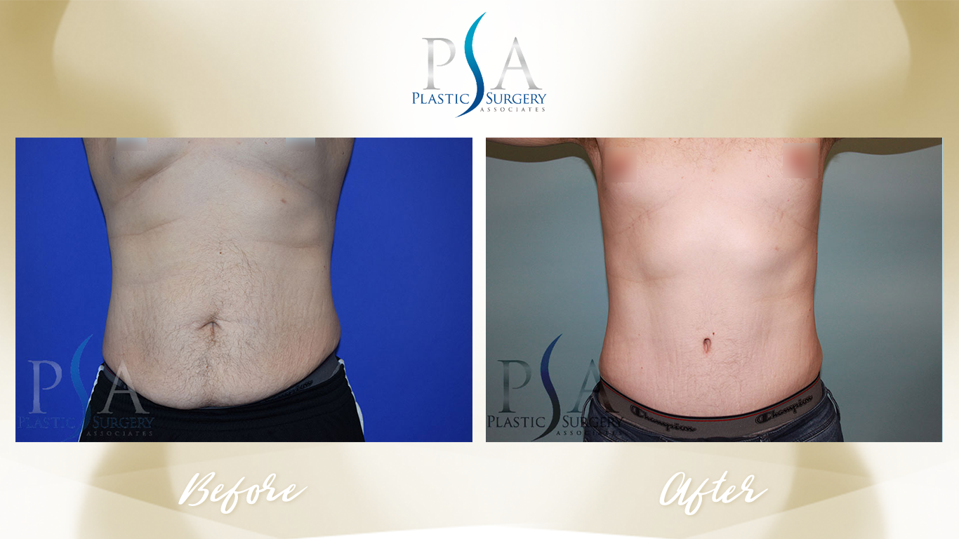 Tummy Tuck result at Plastic Surgeon Associates of Orange County