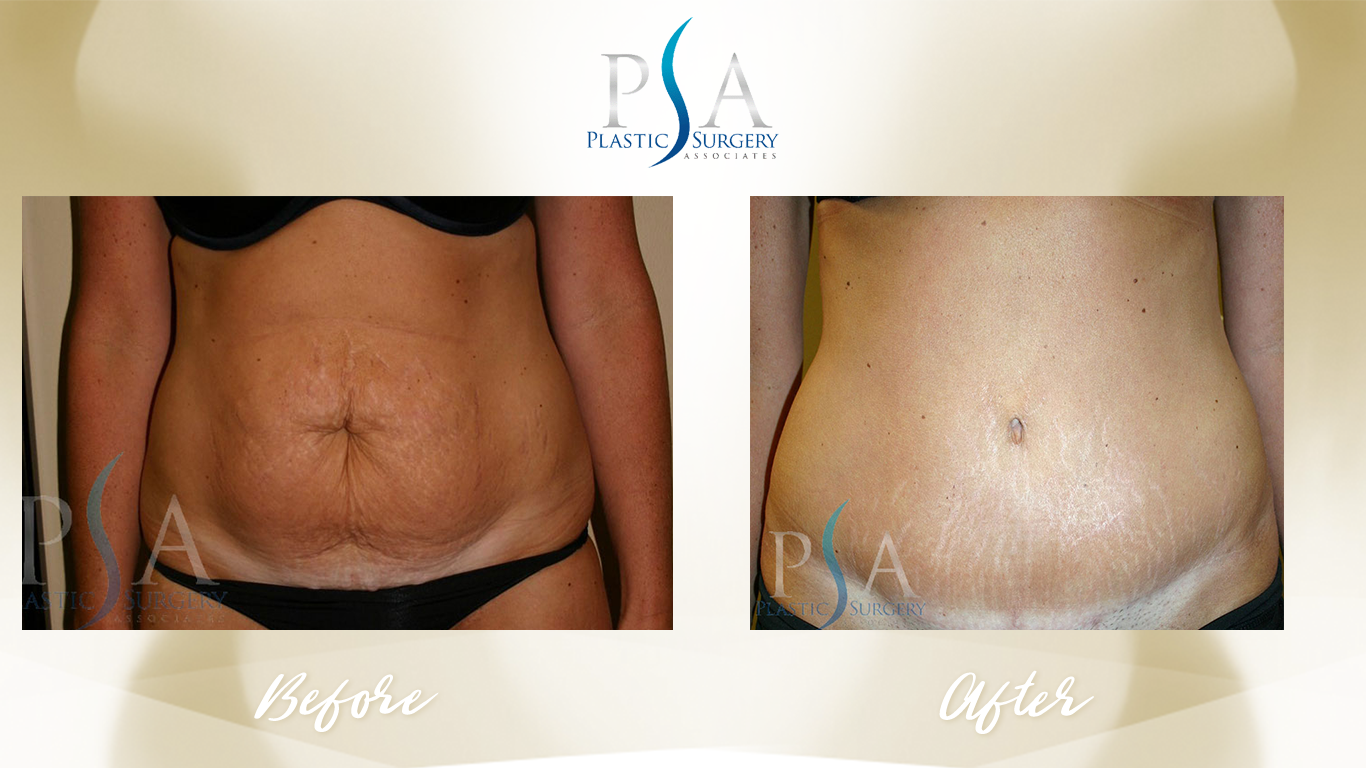 Tummy Tuck result at Plastic Surgeon Associates of Orange County