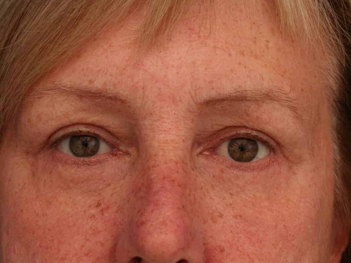 A result from Ronald H. Schuster, MD
