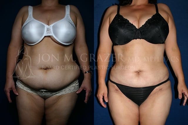 A result from Jon Grazer MD Plastic Surgery & Aesthetics