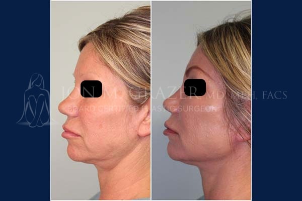 A result from Jon Grazer MD Plastic Surgery & Aesthetics