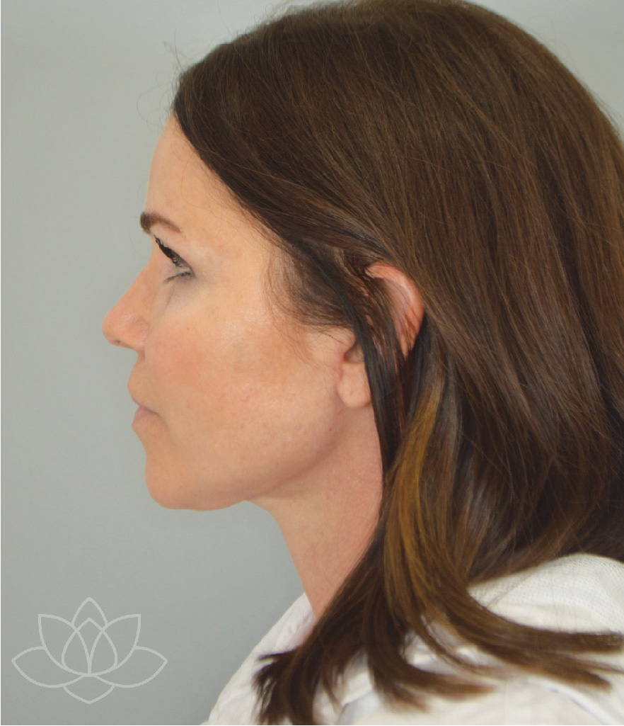 Jordan L. Wallin, MD facelift after — St. George, UT