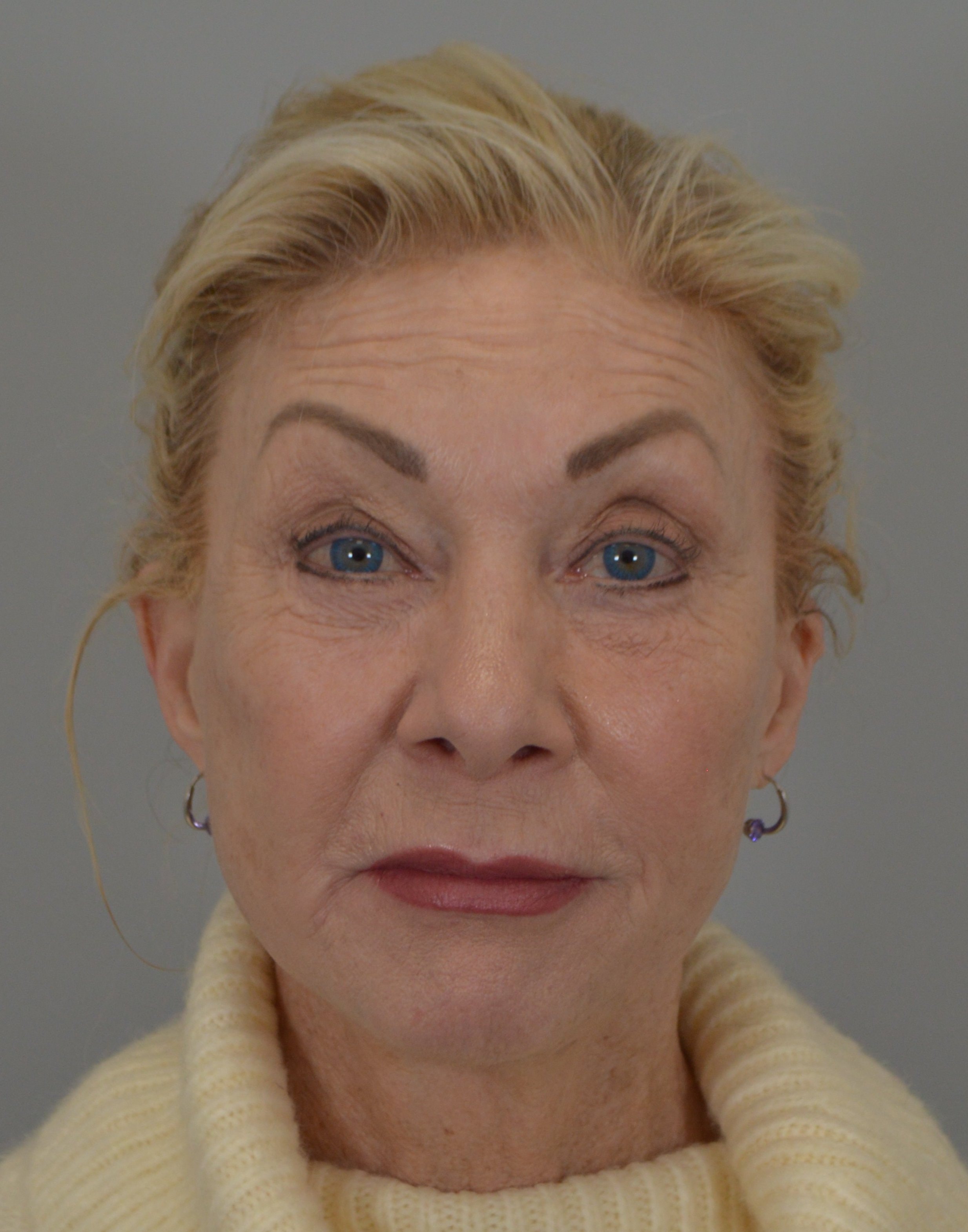A result from Jordan L. Wallin, MD