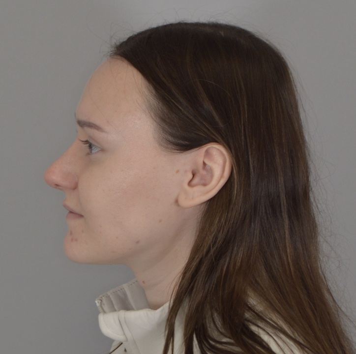 Jordan L. Wallin, MD rhinoplasty after — St. George, UT