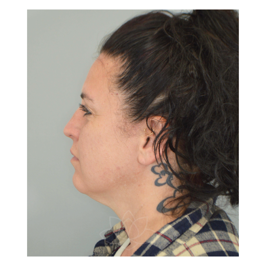 Jordan L. Wallin, MD facelift after — St. George, UT