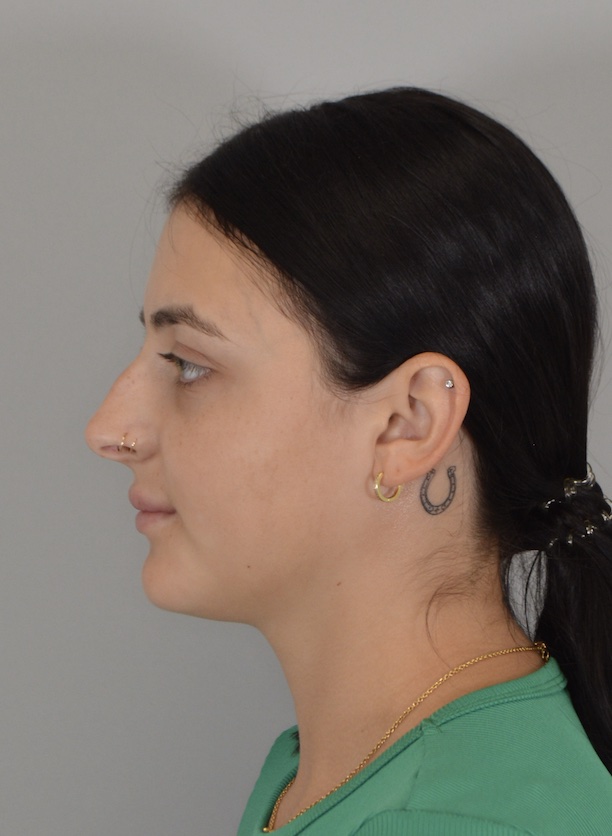 Jordan L. Wallin, MD rhinoplasty after — St. George, UT