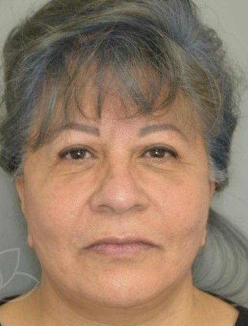 Jordan L. Wallin, MD facelift after — St. George, UT