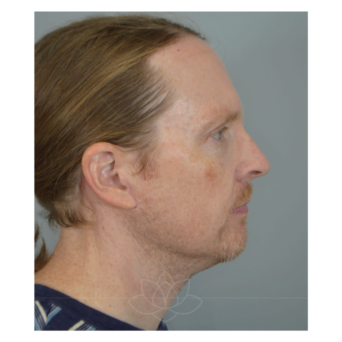 Jordan L. Wallin, MD facelift after — St. George, UT