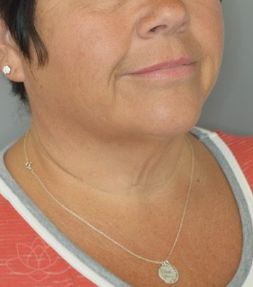 Jordan L. Wallin, MD facelift after — St. George, UT