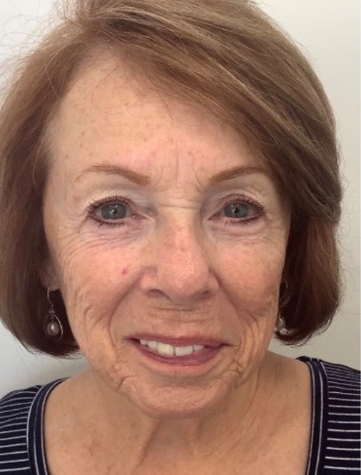 Jordan L. Wallin, MD facelift after — St. George, UT