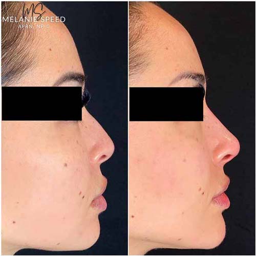Rhinoplasty result at Flawless MedSpa