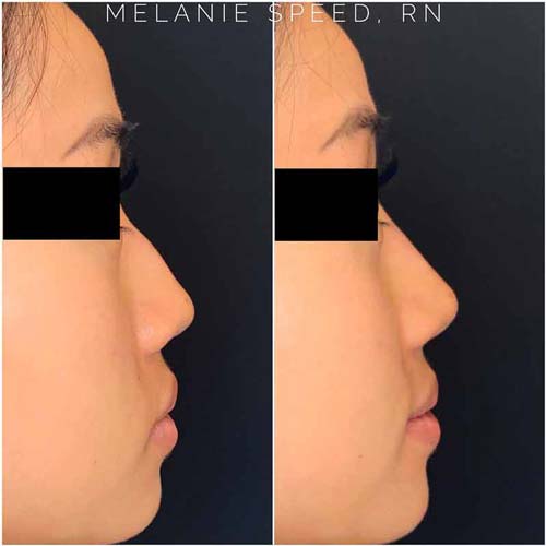 Rhinoplasty before photo