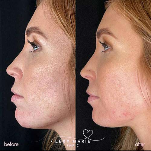 Chin Implant result at Flawless MedSpa