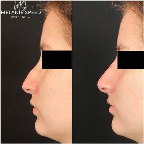Rhinoplasty result at Flawless MedSpa