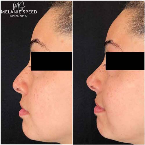 Rhinoplasty before photo