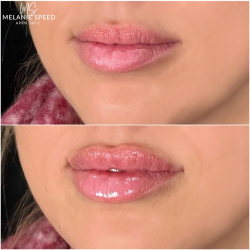 Flawless MedSpa lip filler after — Las Vegas, NV