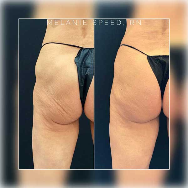 Bbl result at Flawless MedSpa