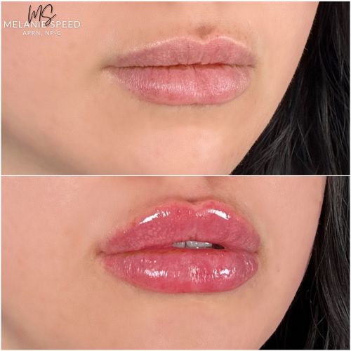 Flawless MedSpa lip filler after — Las Vegas, NV