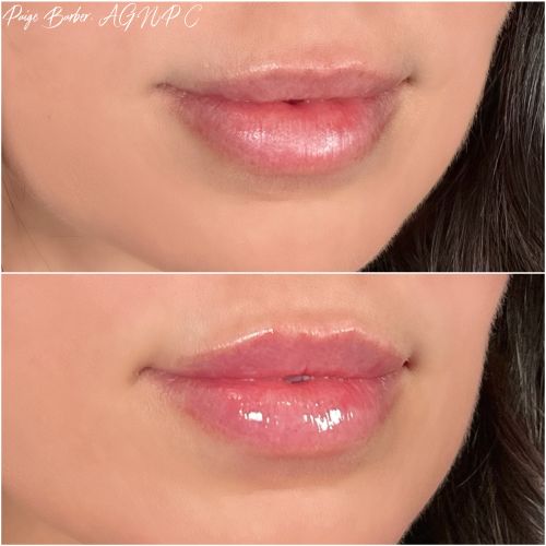 Flawless MedSpa lip filler after — Las Vegas, NV