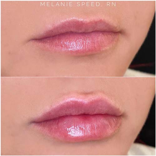 Flawless MedSpa lip filler after — Las Vegas, NV