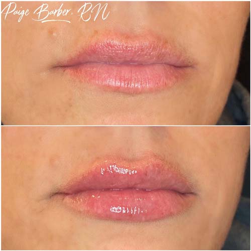 Flawless MedSpa lip filler after — Las Vegas, NV
