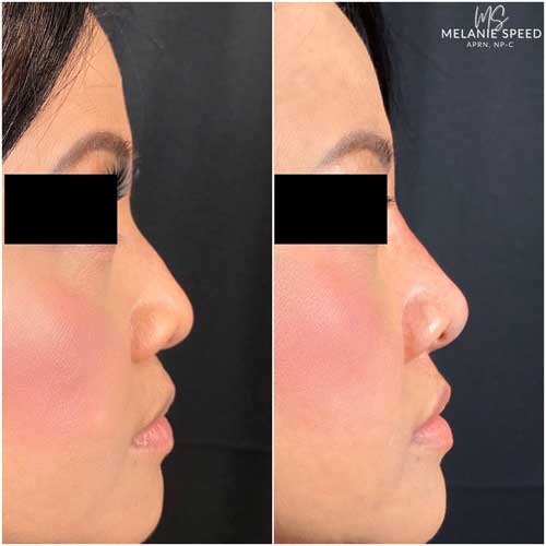 Rhinoplasty before photo