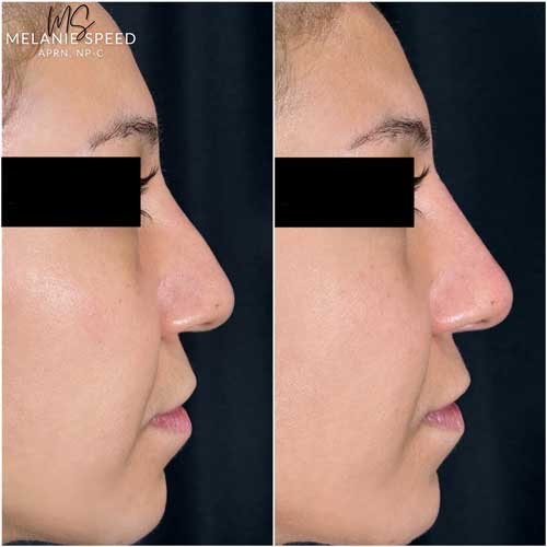 Rhinoplasty result at Flawless MedSpa