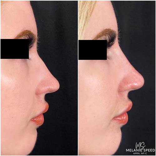 Rhinoplasty before photo