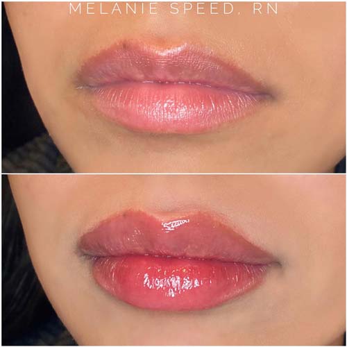 Flawless MedSpa lip filler after — Las Vegas, NV