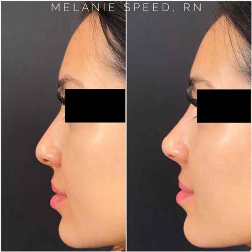 Rhinoplasty result at Flawless MedSpa